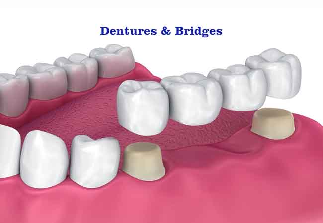 Crown and Bridges