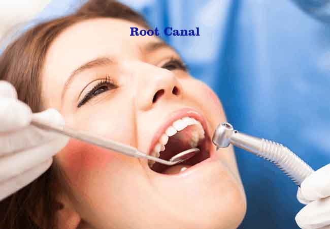 Root canal Treatment