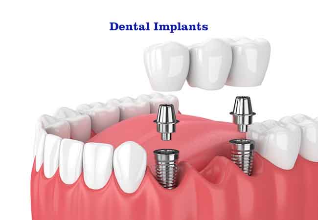 Dental Implants