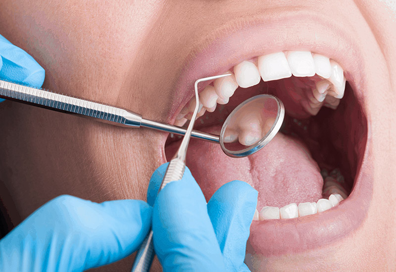 periodontal-surgeries-in-delhi